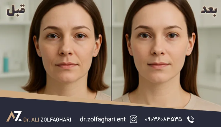 عکس قبل و بعد هایفوتراپی 