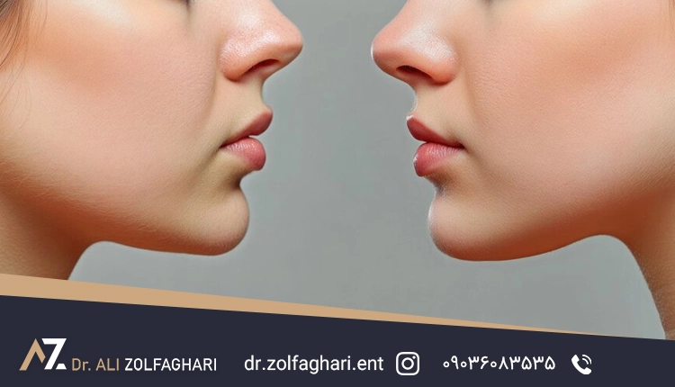 اقدامات قبل از عمل رینوپلاستی | آمادگی جهت عمل بینی