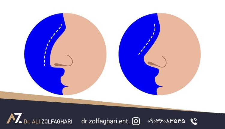 نکات مهم قبل از انجام رینوپلاستی که باید بدانید!