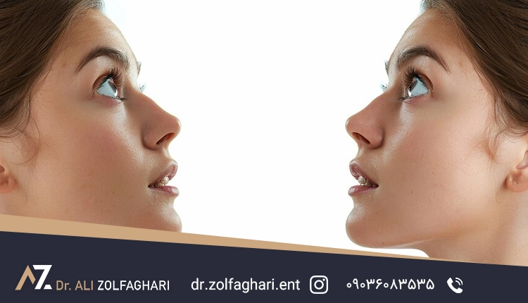 پوست اضافی بینی پس از کوچک شدن بینی در رینوپلاستی چه می‌شود؟