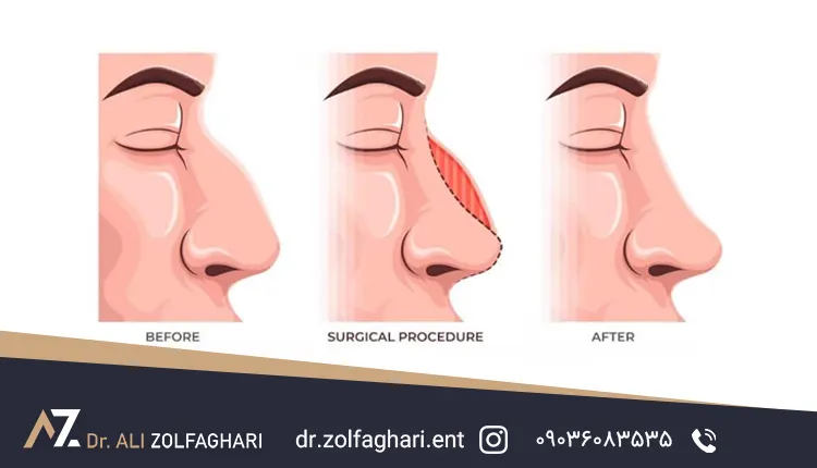 بهبود ظاهر بینی