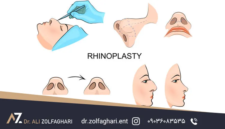 هزینه عمل رینوپلاستی در سال ۱۴۰۴ تهران