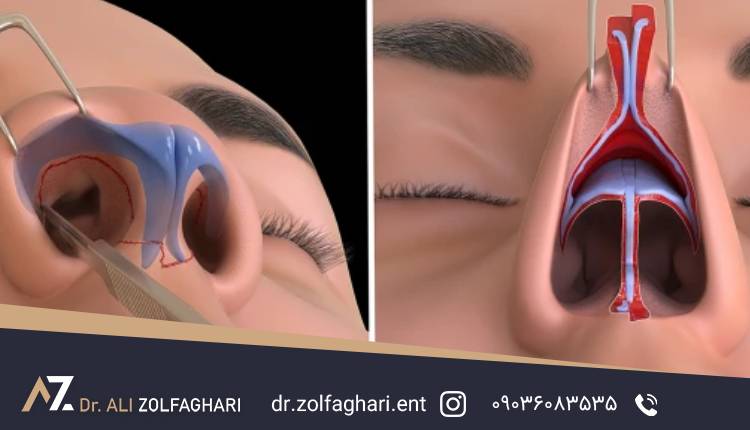 عمل نوک بینی 