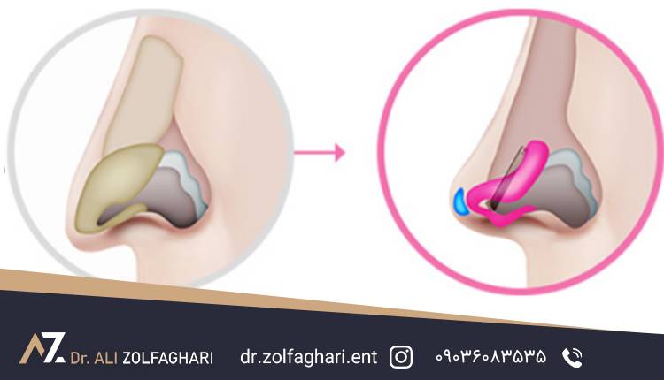 عمل نوک بینی 
