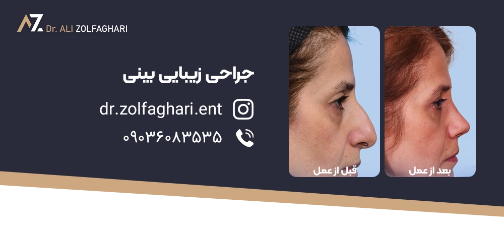 تزریق کورتون به بینی بعد از عمل جراحی