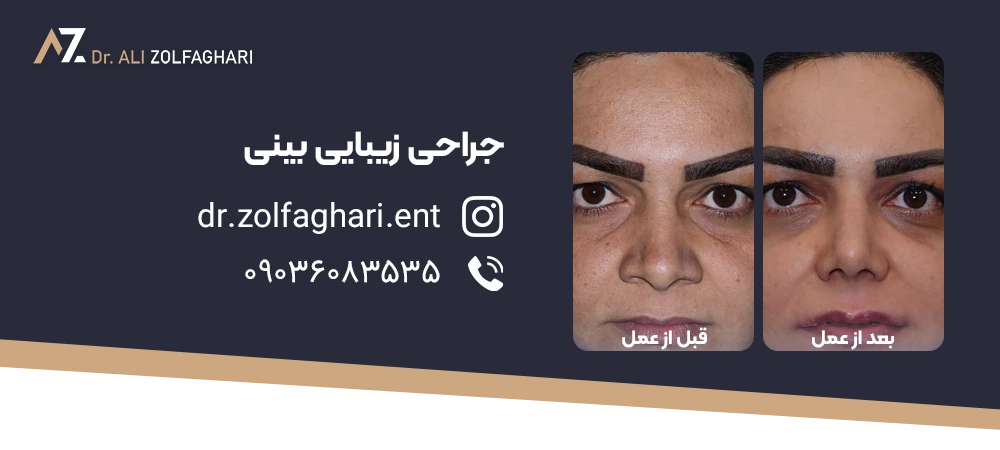 استحمام بعد از جراحی بینی