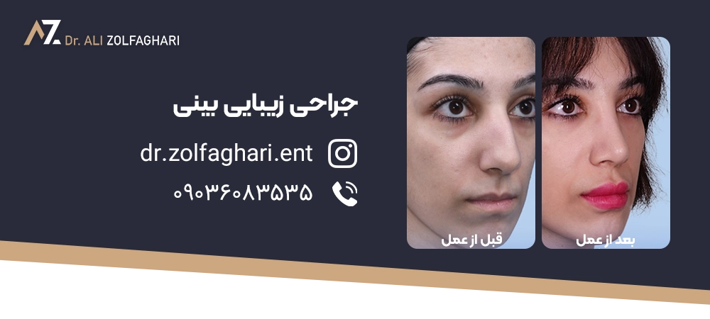 چه کسانی به جراحی بینی با پیوند غضروف نیاز دارند ؟