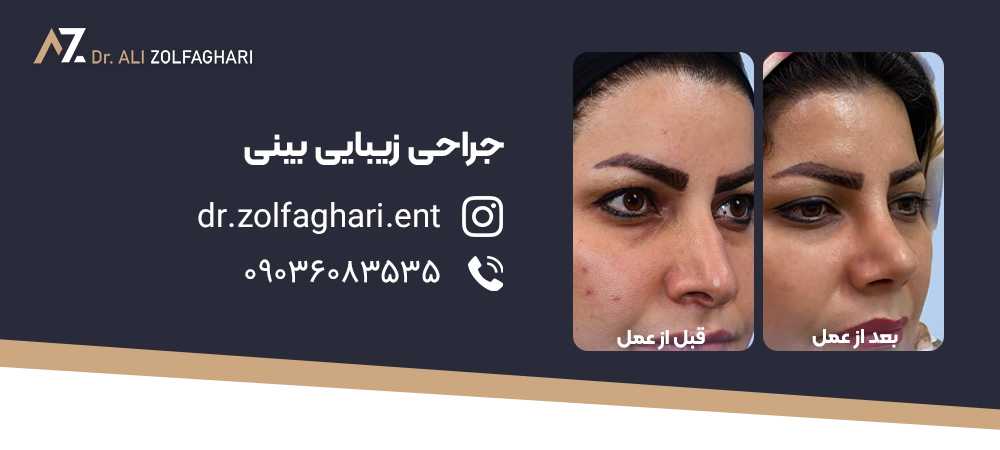 سپتوپلاستی چیست؟