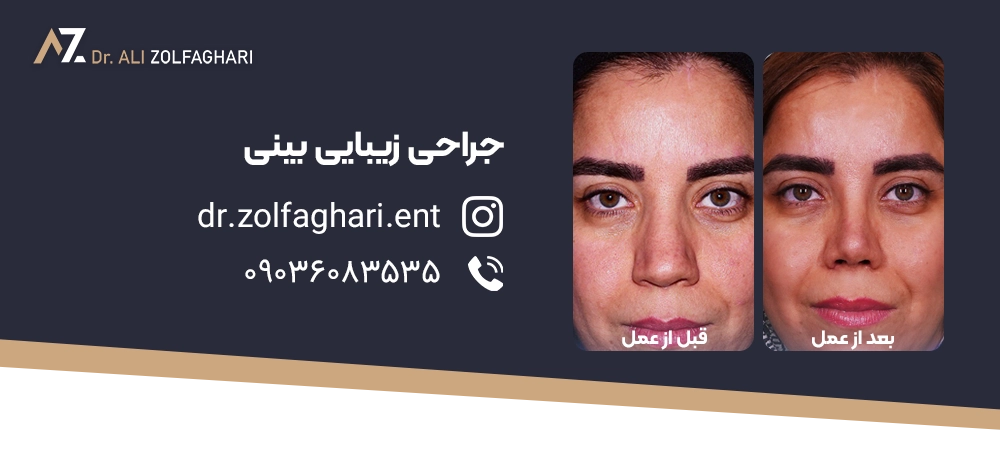 قبل از عمل بینی چه اقداماتی را باید انجام بدهیم؟