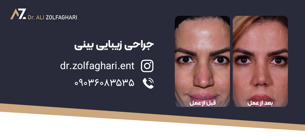 اسپلینت یا گچ بینی چیست و چه کاربردی دارد؟