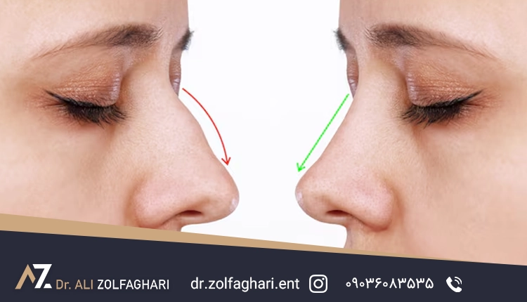 قوز بینی چیست ؟