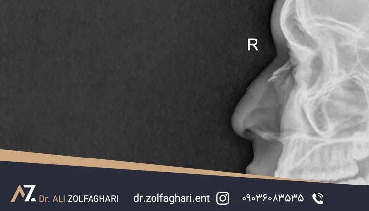 عکس بینی شکسته
