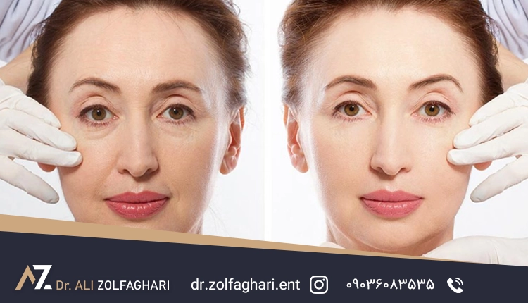 اقدامات قبل از جراحی زیبایی پلک (بلفاروپلاستی)