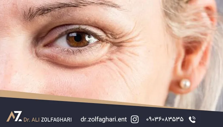جراحی پلک پایین 