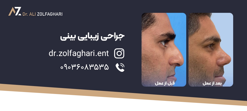 انواع قوس بینی (طبیعی نیمه فانتزی فانتزی) عکس قوس بینی