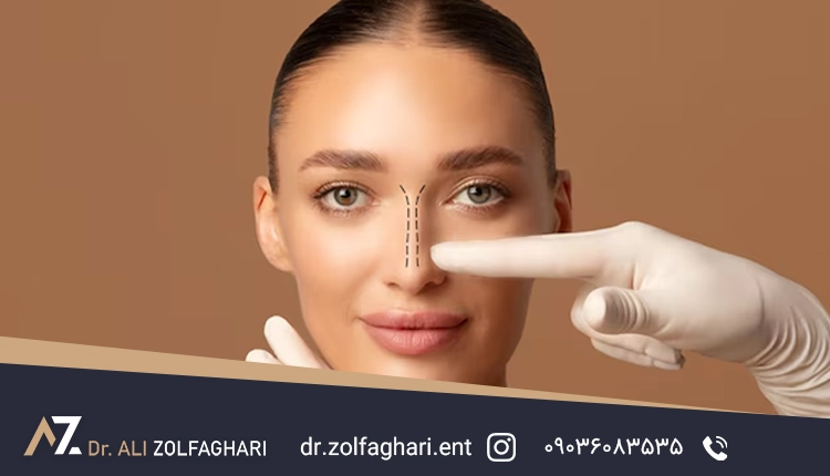 قوس بینی | عمل بینی طبیعی و نیمه فانتزی قوس دار | نمونه کار دکتر ذولفقاری