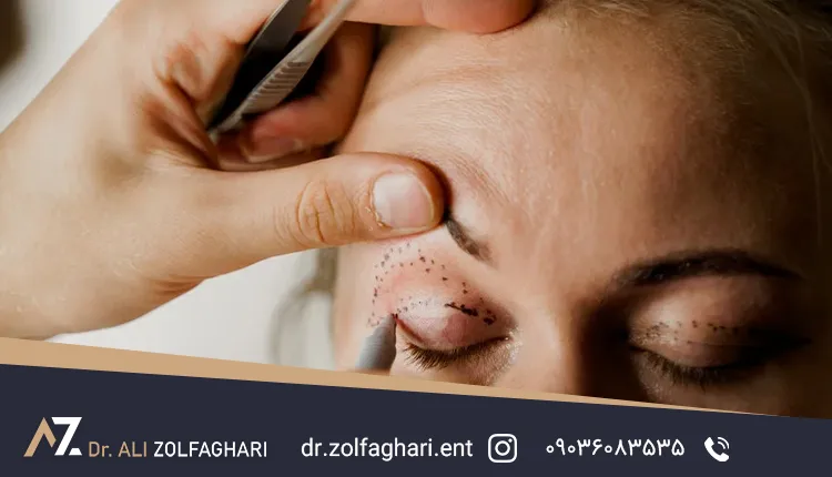 عمل زیبایی چشم چیست؟