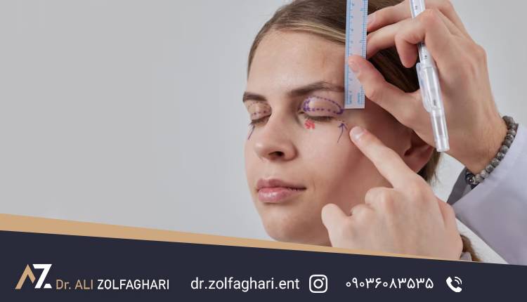 هزینه عمل پلک بالا در تهران