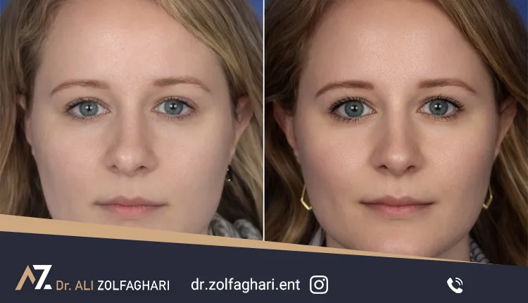 کاهش سردردهای ناشی از انحراف سپتوم
