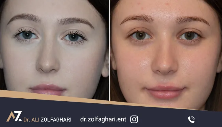 چرا عمل انحراف بینی انجام می‌شود؟