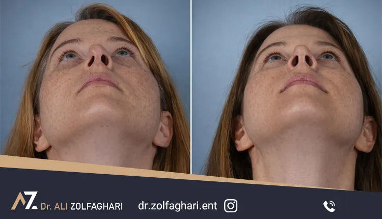 جراحی سپتوپلاستی