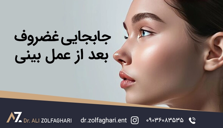جابجایی غضروف بینی بعد از عمل
