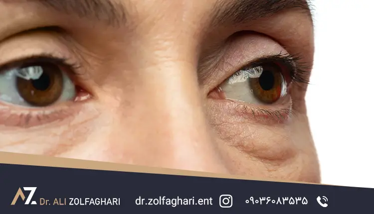 عکس عمل پف زیر چشم 