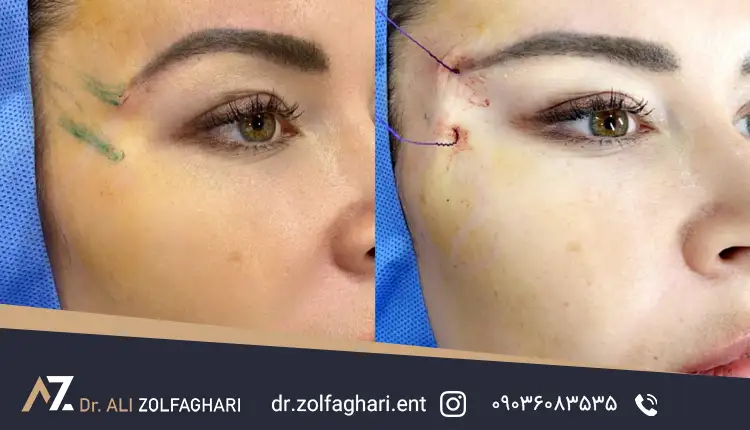 معایب لیفت چشم با نخ