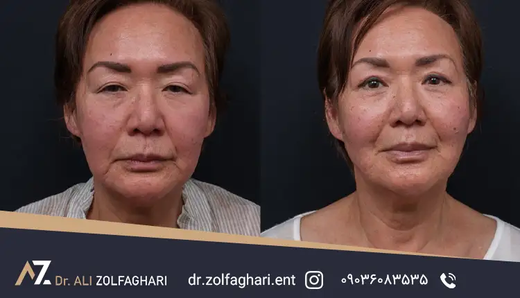 کاهش افتادگی پلک بالا