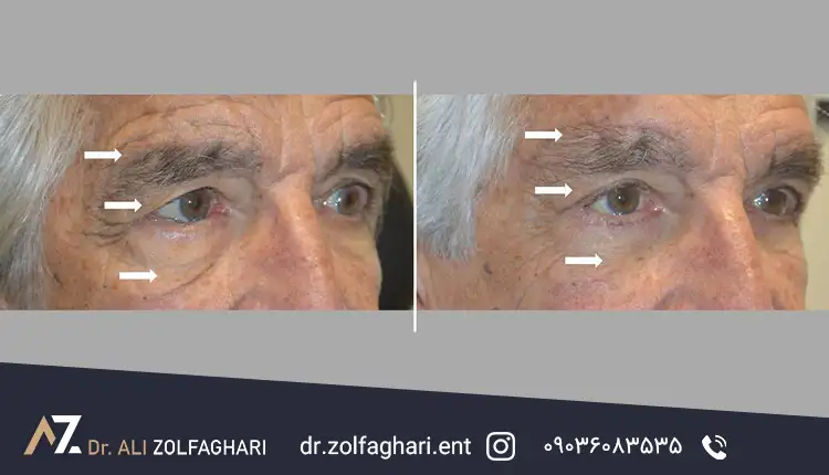 عکس قبل عمل بلفاروپلاستی