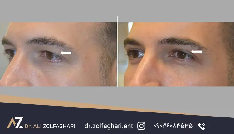 عکس بعد عمل بلفاروپلاستی
