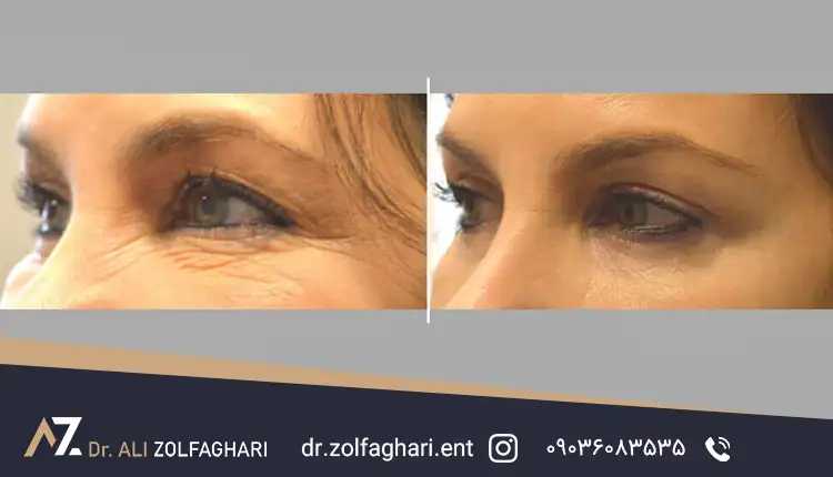 نکات مهم در بررسی عکس قبل و بعد عمل بلفاروپلاستی