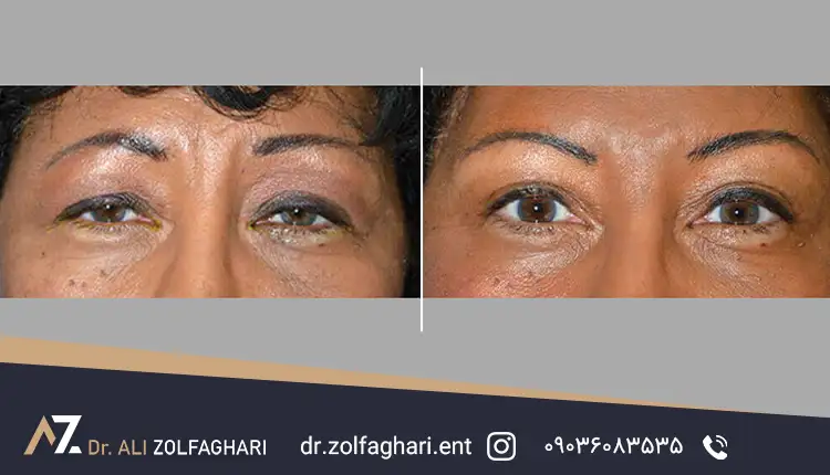 چه تغییراتی را می توان در عکس قبل و بعد جراحی بلفاروپلاستی مشاهده کرد؟