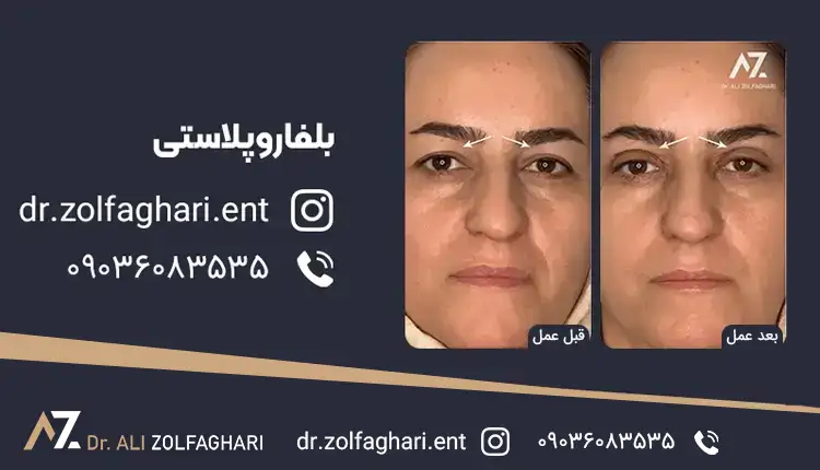 دلایل افتادگی پلک چیست؟