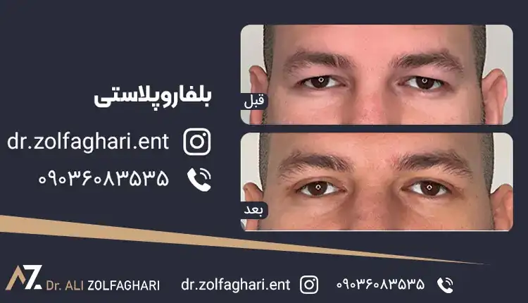 کاهش عوارض عمل بلفاروپلاستی
