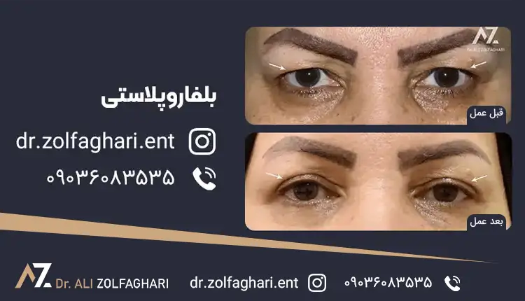 جراحی زیبایی پلک (بلفاروپلاستی)