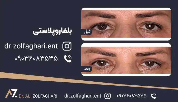 جراحی زیبایی پلک (بلفاروپلاستی)