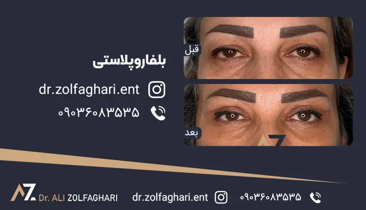 عکس قبل و بعد افتادگی پلک در تهران
