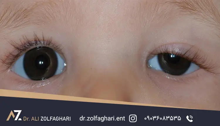 پتوز مادرزادی Congenital Ptosis