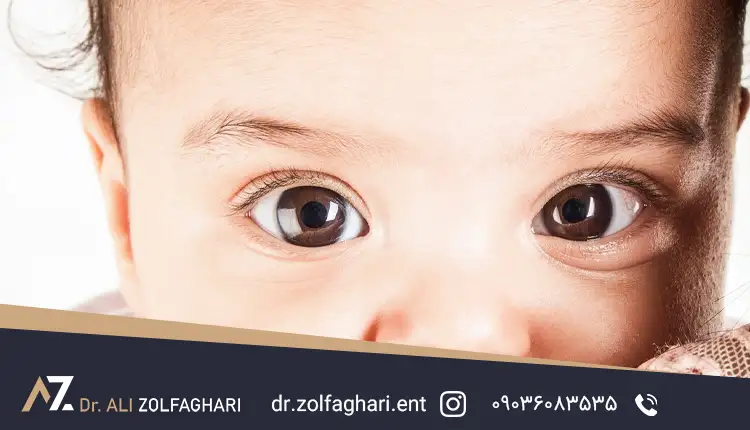 علائم پتوز مادرزادی