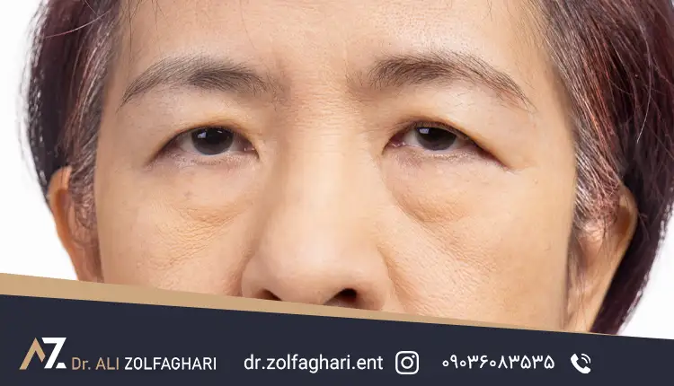 پتوز چگونه درمان میشود