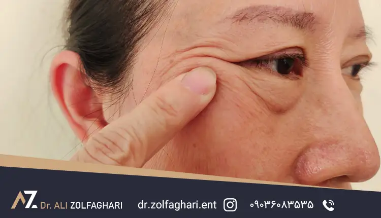 پتوز آپونوروتیک