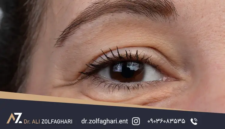 پتوز چشم چیست