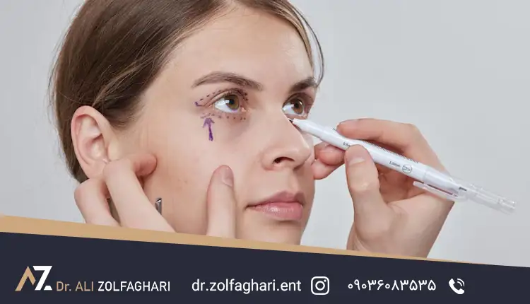 پتوز چشم چیست
