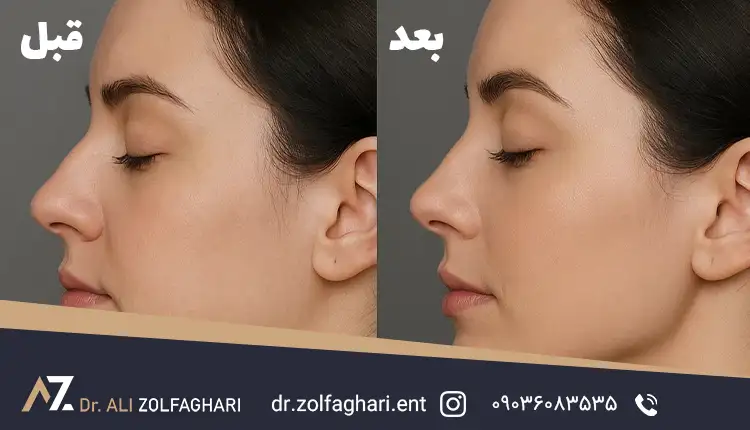 کاندیدای مناسب عمل بینی بدون چسب