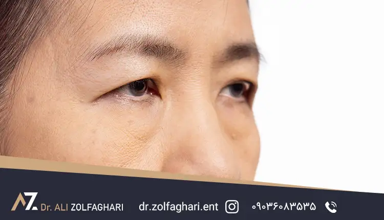 زمان انجام جراحی بلفارو پلاستی