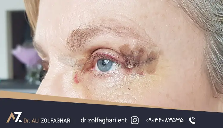 کاهش عوارض عمل بلفاروپلاستی