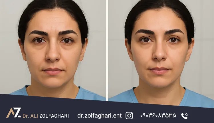 لیفت ابرو با جراحی