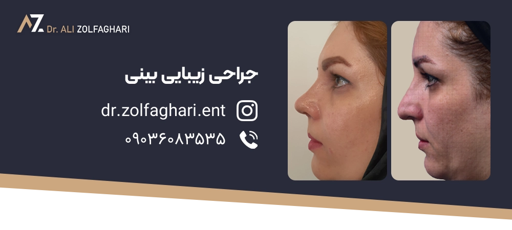 عکس قبل و بعد جراحی زیبایی بینی