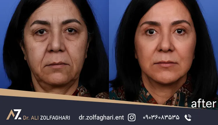 عکس عمل کشیدن پوست صورت